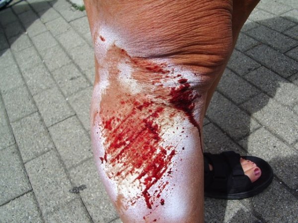 Blessure à Lili.